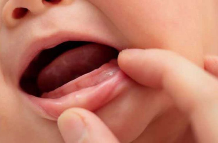 Dấu hiệu mọc răng ở trẻ 5 tháng tuổi và cách giúp con dễ chịu hơn Trẻ 5 tháng tuổi có thể mọc răng sớm, nhưng không phổ biến