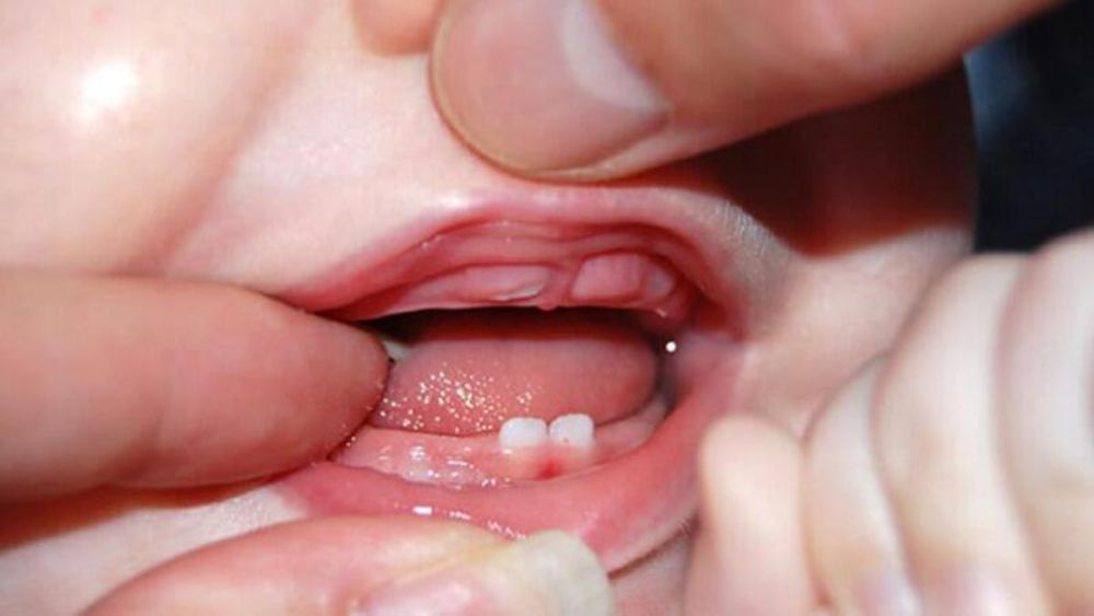 Răng mọc đúng hướng, bé vẫn ăn ngủ tốt là tín hiệu đáng mừng, mẹ không cần lo lắng!