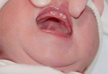 Nanh sữa (trái) thường nổi gồ trên đỉnh nướu, trong khi nốt Epstein (phải) thường xuất hiện trên vòm miệng.