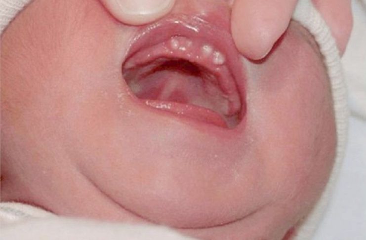 Nanh sữa (trái) thường nổi gồ trên đỉnh nướu, trong khi nốt Epstein (phải) thường xuất hiện trên vòm miệng.